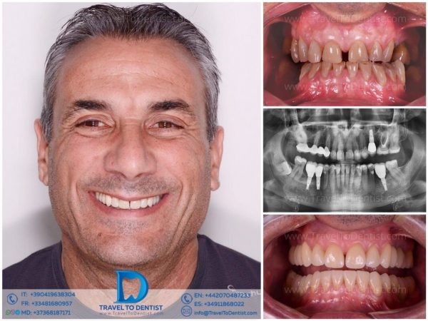 Caso clínico 2: transformación dental realizada por el equipo de Dental Moreno